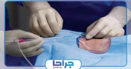 اقدامات قبل از آنژیوپلاستی