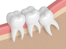 عوارض کشیدن دندان عقل چیست؟