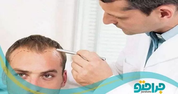 توصیه های مراقبتی پیش از کاشت مو