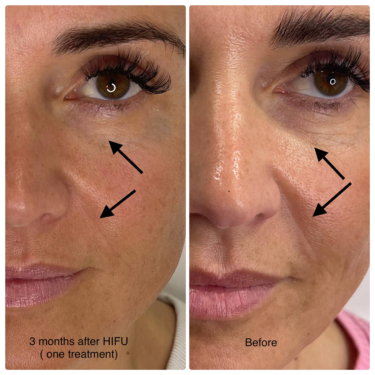 بهترین مرکز هایفوتراپی کرمان