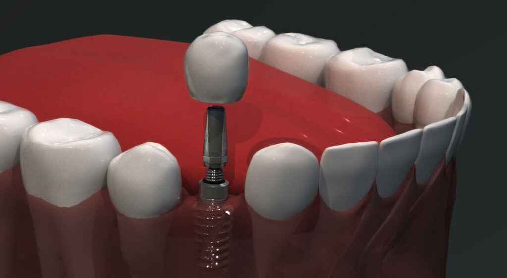 قیمت ایمپلنت دندان