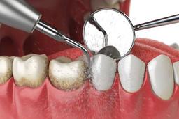 جرمگیری دندان چگونه انجام می‌شود؟