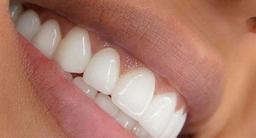 آیا کامپوزیت کردن دندان‌های جلو طبیعی است؟