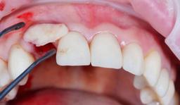 درمان شکستن دندان جلو از ریشه + ترمیم دندان جلویی