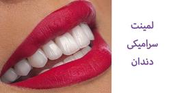 نحوه لمینت کردن دندان‌ + مقایسه لمینت با کامپوزیت