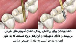 آیا برداشتن روکش دندان درد دارد؟