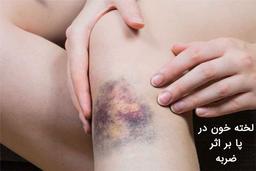 لخته شدن خون در پا بر اثر ضربه + عوارض