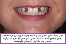 مینی ایمپلنت چیست و چه تفاوتی با ایمپلنت معمولی دارد؟