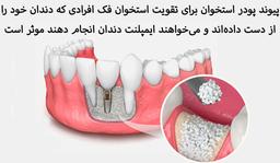 مراقبت‌های بعد از پودر استخوان در ایمپلنت دندان