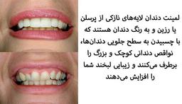 لمینت دندان چقدر طول می‌کشد؟
