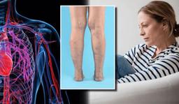 آیا بیماری واریس به قلب ربط دارد؟