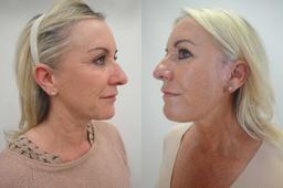 کدام ایرادات صورت توسط لیفت صورت برطرف میشود ؟