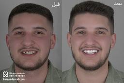 دندانپزشکی اقساطی در مشهد + قیمت ایمپلنت دندان مشهد