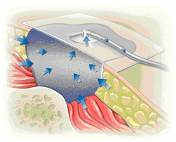وکیوم تراپی و درمان زخم با فشار منفی(NPWT)