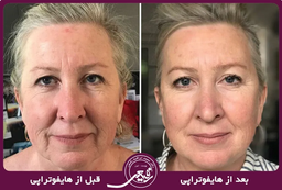 هایفوتراپی صورت برای از بین بردن جای جوش و لک صورت