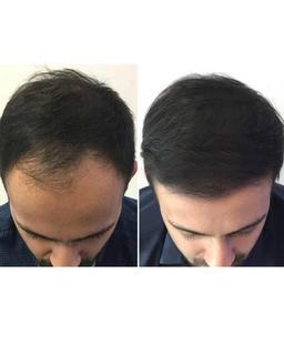 پی آر پی مو (prp) چیست و چه نقشی در تقویت مو دارد؟