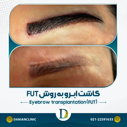 همه چیز درباره کاشت ابرو