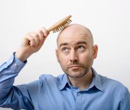 آشنایی با عوارض بعد از کاشت مو