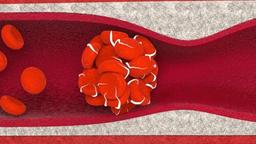 ادامه نکاتی برای پیشگیری از لخته های خون بعد از عمل جراحی