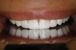 لیرینگ چیست؟