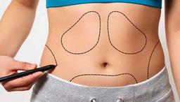 چرا لیپو شکم را برای لاغری انتخاب کنید؟