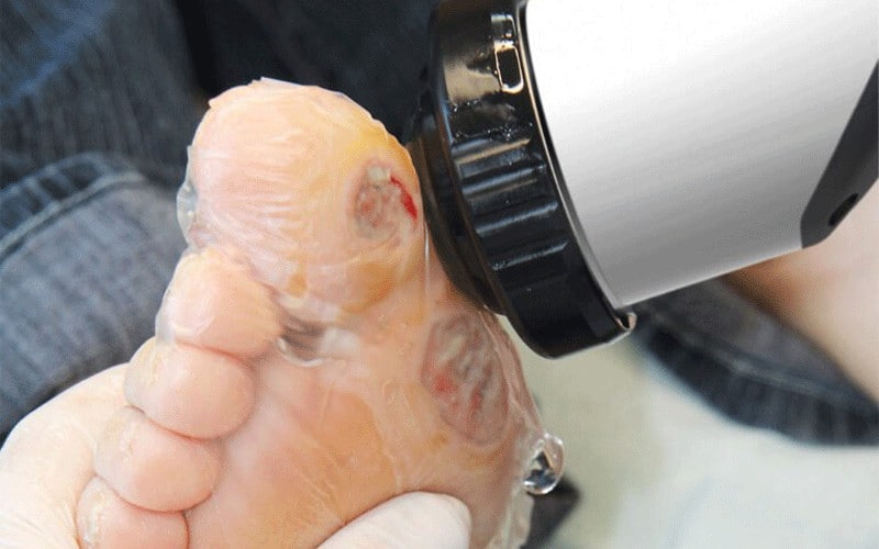 پاکسازی زخم با امواج فراصوت