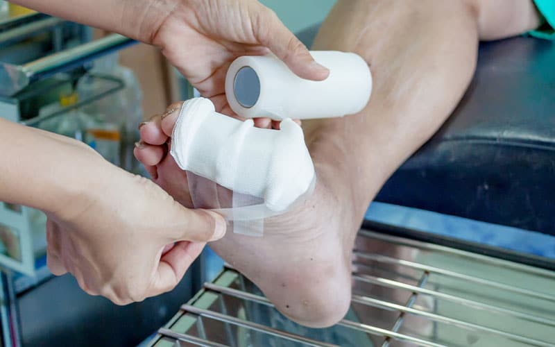 پانسمان نوین برای زخم پای دیابتی