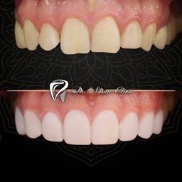 کامپوزیت یا لمینت؟ مسئله این است!