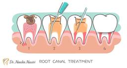 عصب کشی دندان چیست و چه مراحلی دارد؟
