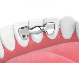 انواع مختلف بریج دندان کدامند؟