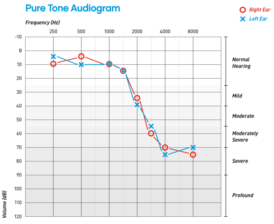 یک نمونه از شنوایی نگار