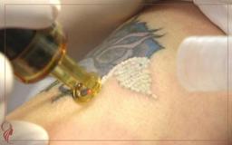 ازبین بردن تاتو ابرو با لیزر