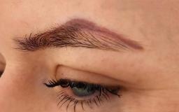 لیزر، بهترین روش برای پاک کردن تاتو ابرو