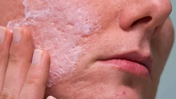 از بین بردن لک ها با انجام مزوتراپی در کلینیک