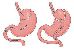 اسلیو معده بهتر است یا بایپس ؟