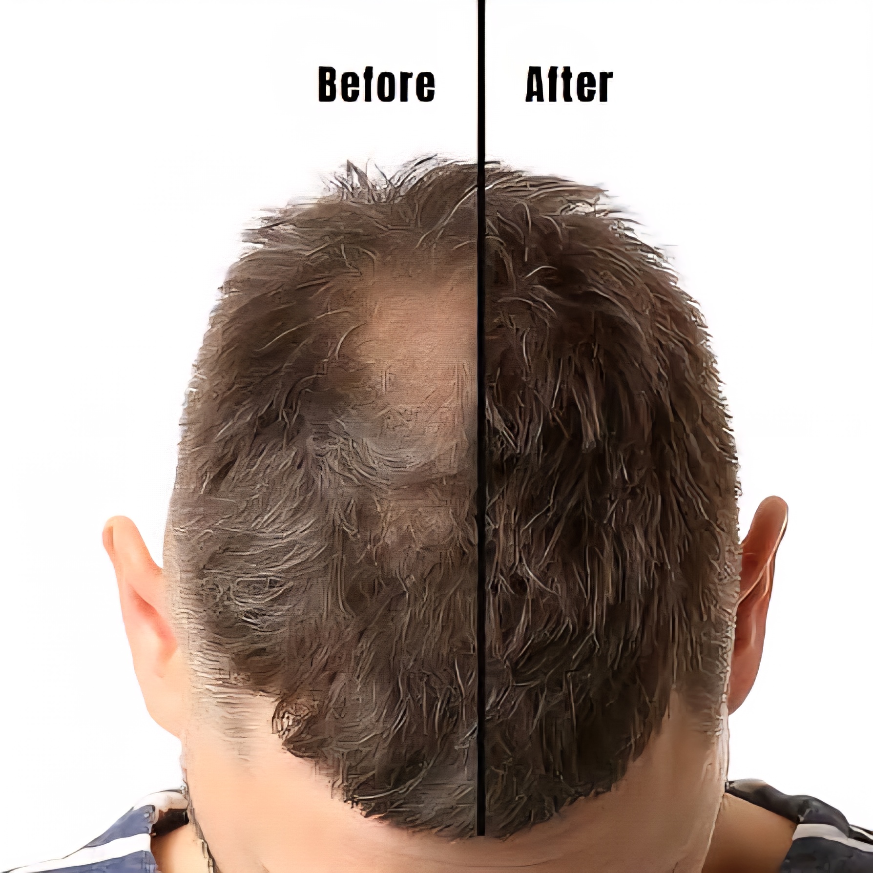 اثرات Minoxidil طی چندماه