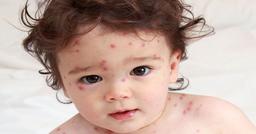 درمان خانگی آبله مرغان