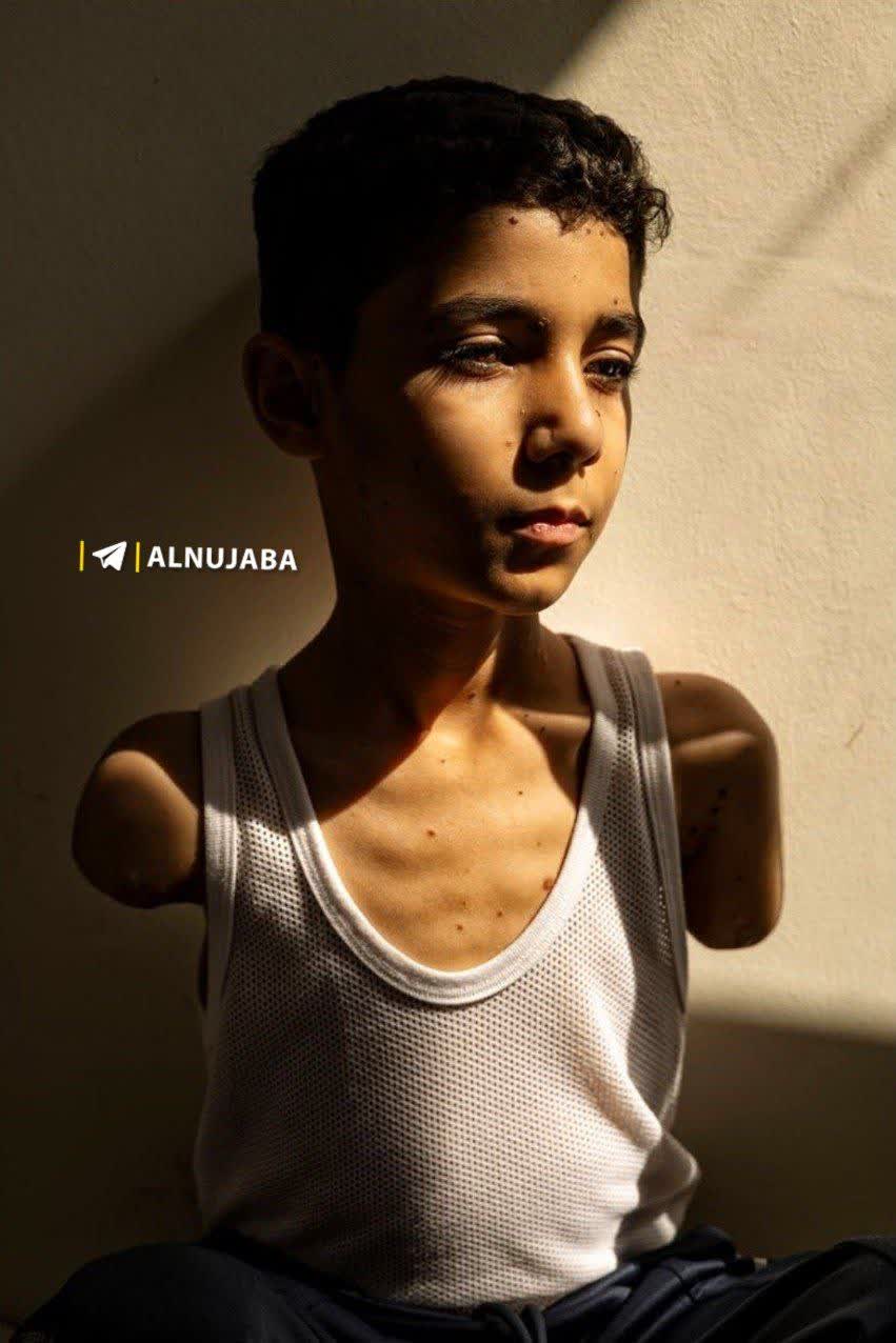 تصویر کودک فلسطینی بدون دست ، بهترین عکس خبری سال ۲۰۲۵ شد !