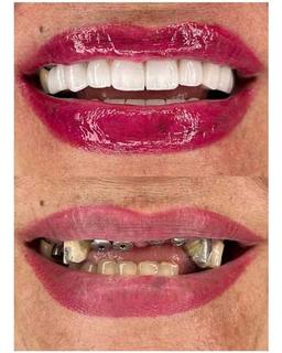 ایمپلنت دندان و سوالات در مورد آن