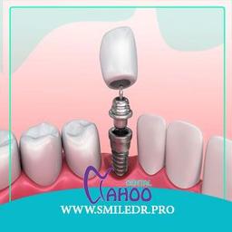 عوارض خطرناک ایمپلنت دندان