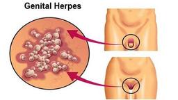 زگیل تناسلی چیست؟ راه های انتقال و درمان آن در زنان و مردان