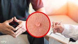 از کجا بفهمیم زگیل تناسلی داریم؟ آیا زگیل قابل درمان است؟