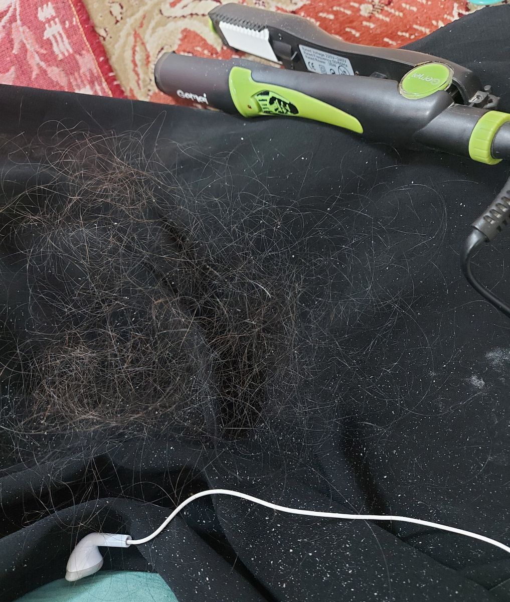 ریزش شدید مو و شوره سر