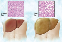 کبد چرب، بیماری خاموش