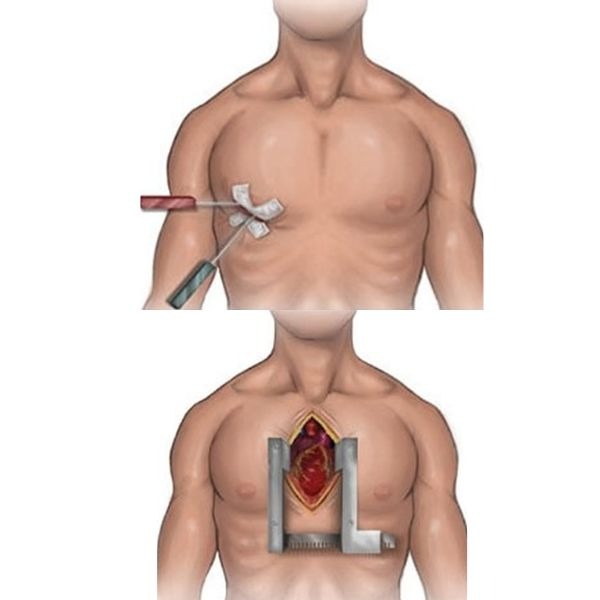 نمایی از تفاوت جراحی کم تهاجمی قلب و جراحی قلب باز