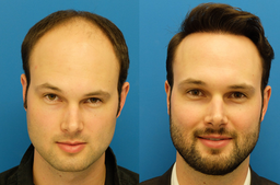 همه چیز درباره کاشت مو و سن مناسب آن