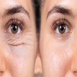 بلفاروپلاستی چیست و چه عوارضی دارد