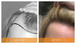 مهمترین نکات کاشت مو را در این مقاله بخوانید