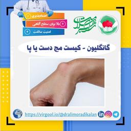 گانگلیون - کیست مچ دست یا پا