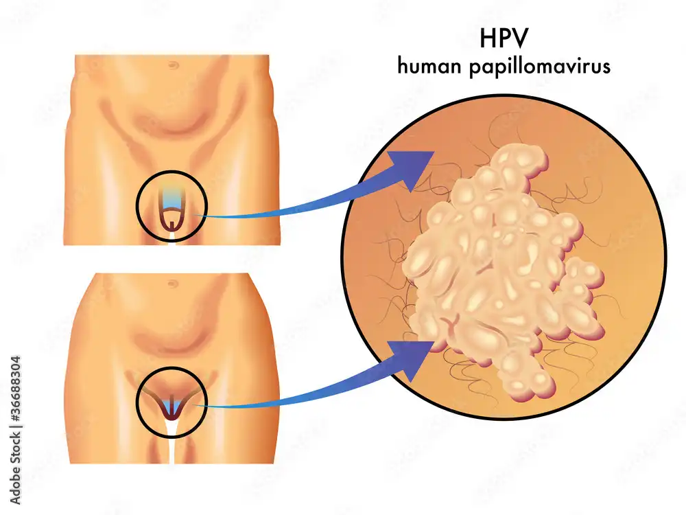 HPV